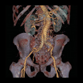 Aorta with skeletal anatomy